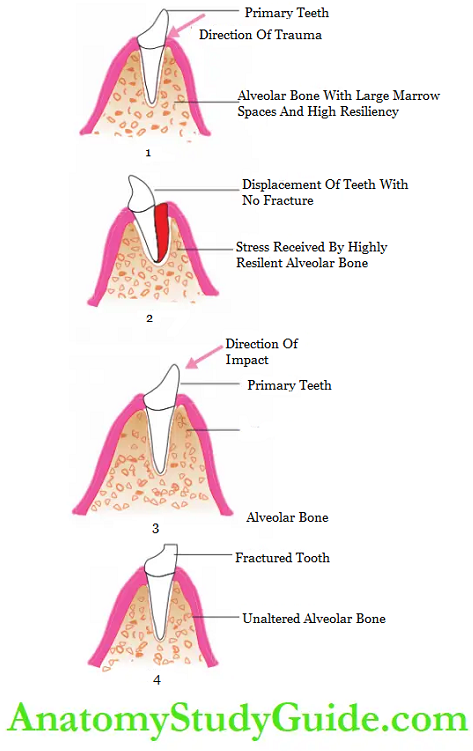 Dental Injuries in Primary dentition Luxation injuries versus tooth fractures in primary Defection