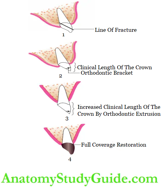 Dental Injuries to Permanent teeth in mixed definition Orthodontic extrusion of the residual tooth structure followed by restoration at the crown fracture