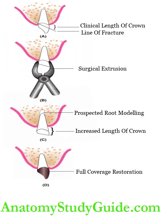 Dental Injuries to Permanent teeth in mixed definition Surgical extrusion of the residual tooth structure followed by restoration at the crown root fracture site