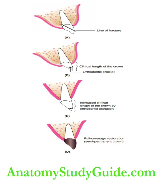 Dental Injuries To Permanent Teeth In Mixed Dentition Notes - Anatomy ...