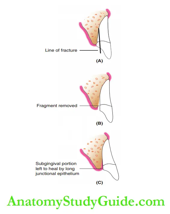 Dental Injuries to Permanent teeth in mixed denifition Process of supragingival restoration at the crown–root facture site