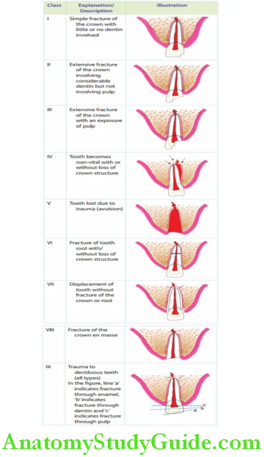Dental Traumatology An Overview ellis and deweys classification with corresponding illustrations