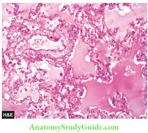 Derangements Of Homeostasis And Haemodynamics Pulmonary Oedema .