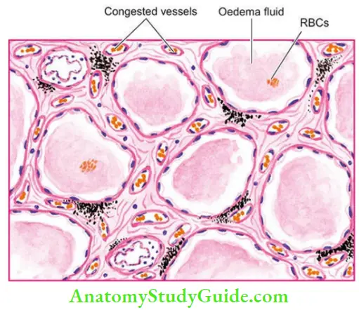Derangements Of Homeostasis And Haemodynamics Pulmonary Oedema