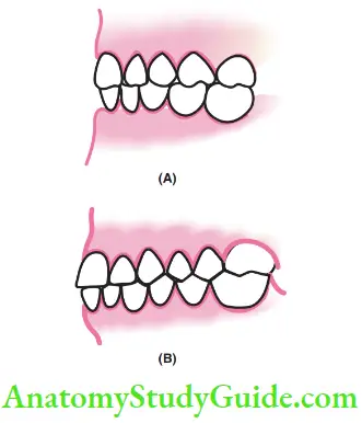 Development Of Occlusion (A)Shallow Intercuspal Interdigitation In Primary Molars When Compared With (B)Well Defined Intercuspation In Permanent Teeth
