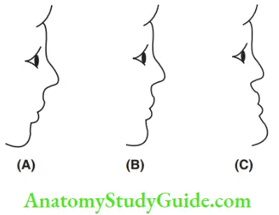 Development Of Occlusion Diagrammatic Representation Of The Facial Profiles Generally Associated With The Three Types Of Jaw Relationships