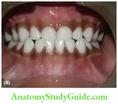 Development Of Occlusion Non-Spaced Or Closed Dentition