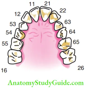 Development Of Occlusion Teeth Seen During The Intertransition Period In Maxillary Arch