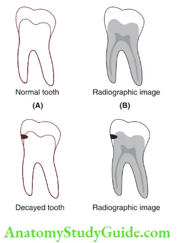 Diagnosis And Removal Of Dental Caries Radiographs