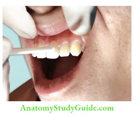 Diagnostic Procedures Notes Application of heated gutta-percha stick on tooth for heat test.