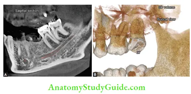 Diagnostic Procedures Notes CBCT showing- Sagittal section of mandible; 3D image of maxillary molars
