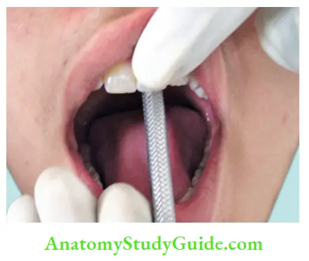 Diagnostic Procedures Notes Checking mobility of a tooth using blunt end of instrument.