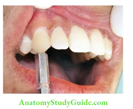 Diagnostic Procedures Notes Percussion of tooth using blunt handle of mouth mirror.