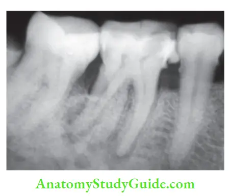 Diagnostic Procedures Notes Radiograph showing extra root in fist molar.