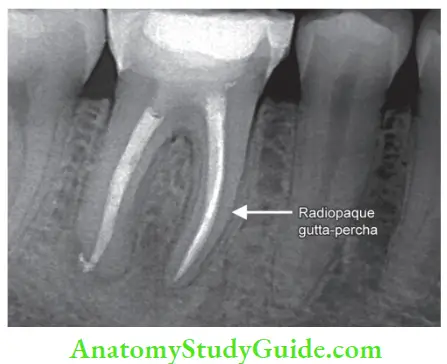 Diagnostic Procedures Notes Radiograph showing obturation in mandibular fist molar