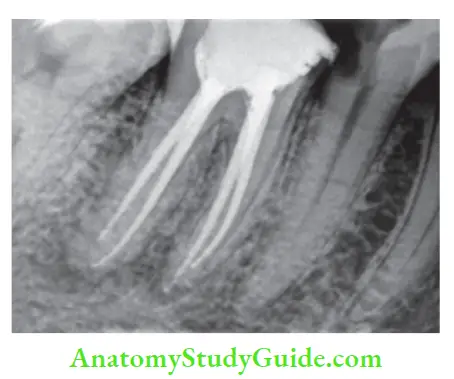 Diagnostic Procedures Notes Radiograph showing obturation of mandibular fist molar.
