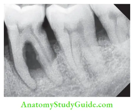 Diagnostic Procedures Notes Radiograph showing periodontal involvement of mandibular fist molar