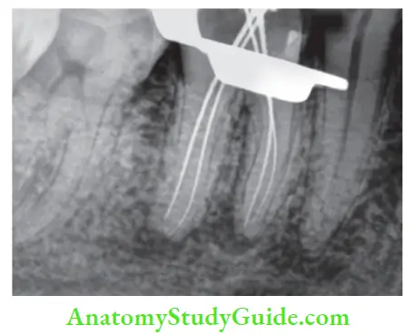 Diagnostic Procedures Notes Working length radiograph.