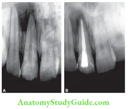 Diagnostic Procedures Notes comparison of size of periapical radiolucency. Preoperative; 6 months post-treatment.