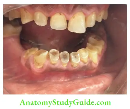 Diagnostic Procedures Notes generalized tooth wear.