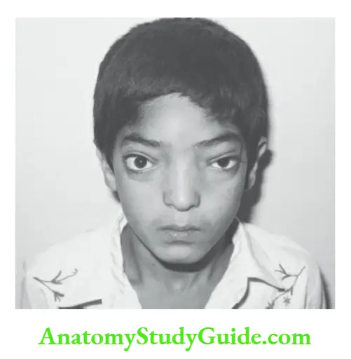 Differaential diagnosis of common abnormal physical signs Hypertelorism with mongoloid slant of eyes.