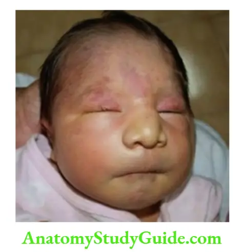 Differaential diagnosis of common abnormal physical signs Note long philtrum and thin upper lip in an infant with fetal hydantoin syndrome.