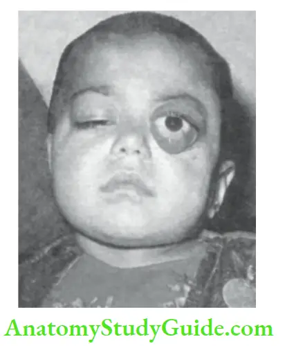 Differaential diagnosis of common abnormal physical signs Proptosis of left eye due to rhabdomyosarcoma.