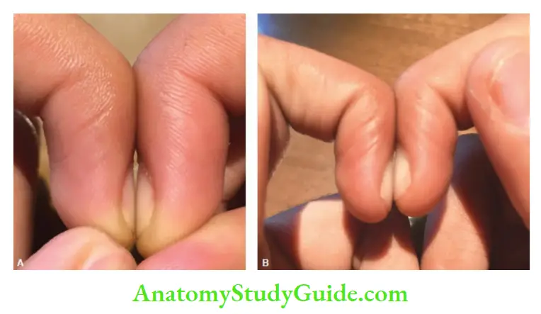Differaential diagnosis of common abnormal physical signs Schamroth sign (A) The diamond-shaped space is seen normally at the base of nail beds when terminal phalanges