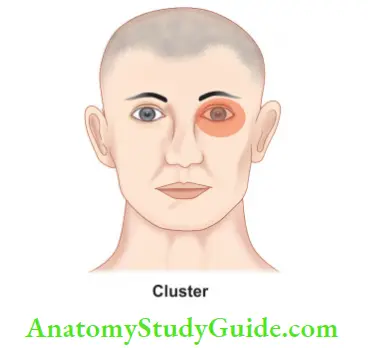 Differential Diagnosis Of Orofacial Pain In cluster headache, pain is often around eyes.