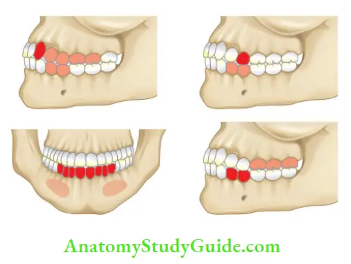 Differential Diagnosis Of Orofacial Pain Referred pain showing involved tooth (red color) and teeth affcted (orange color)