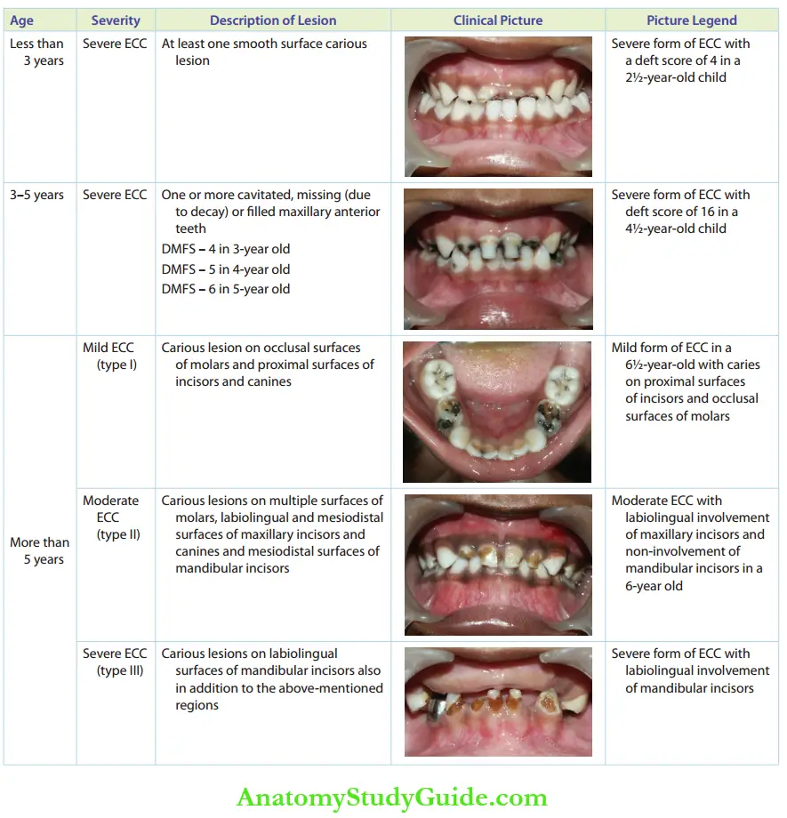 Early Childhood Caries Extent Of Carious Involvement And Age In Early Childhood Caries