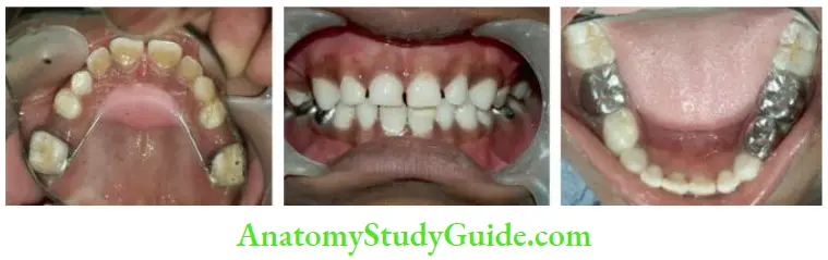 Early Childhood Caries Full Mouth Rehabilitation Of A 4 Year Old Inflicted With Moderate Type ECC