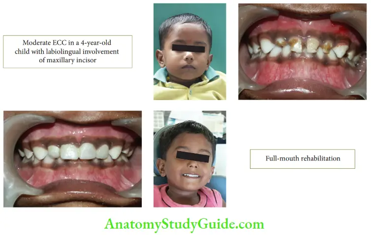 Early Childhood Caries Moderate ECC In A 4 Year Old Child With Labiolingual Involvement Of Maxillary Incisor