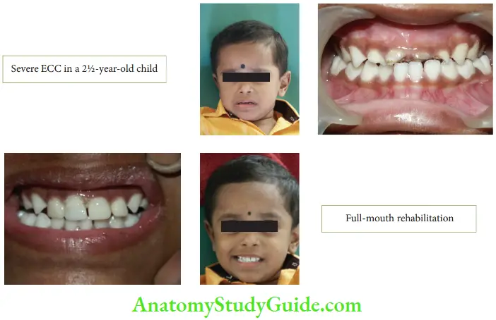 Early Childhood Caries Severe ECC In A 2 And Half Year Old Child