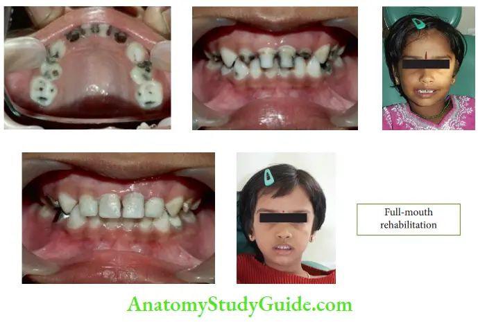 Early Childhood Caries Severe ECC With A Deft Score Of 16 In A 4 And Half Year Old Child