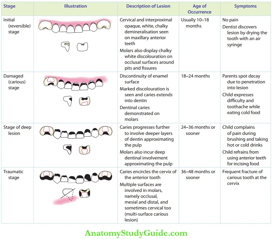 Early Childhood Caries Stages Of Progression Of Early Childhood Caries