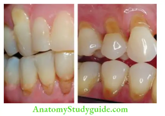 Endodontic Emergencies Abrasion of teeth may lead to dentin hypersensitivity.