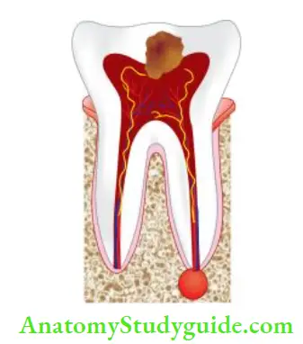 Endodontic Emergencies Acute periapical abscess results due to severe inflammatory response to microorganisms and their byproducts which have leached into periradicular tissues