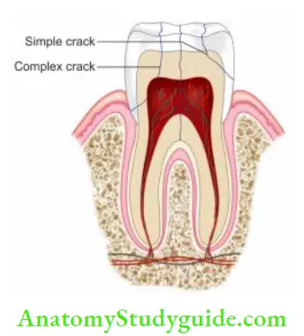 Endodontic Emergencies Diffrent types of cracks in teeth.