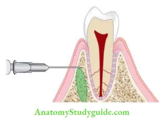 Endodontic Emergencies Intraosseous injection.