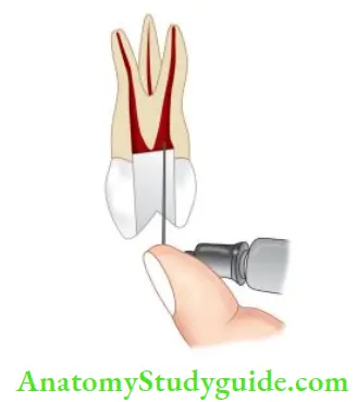 Endodontic Emergencies Intrapulpal injection