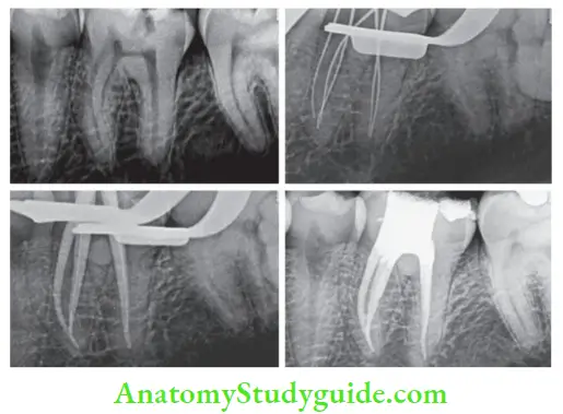 Endodontic Emergencies Management of mandibular molar with acute irreversible pulpitis