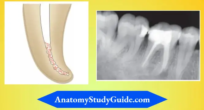 Endodontic-Failures-And-Retreatment-Accumulation-of-dentin-chips-and-debris-cause-incomplete-instrumentation-of-apical-third-of-the-canal