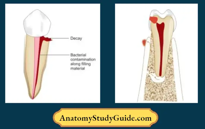 Endodontic-Failures-And-Retreatment-Decay-at-subgingival-area-below-crown-can-result-in-contamination-of-root-filing-and-contribute-to-endodontic-failure