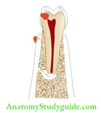 Endodontic Failures And Retreatment Endodontic periodontal communication results in endodontic failure.