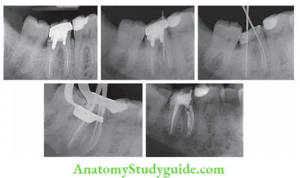 Endodontic Failures And Retreatment Endodontic retreatment of mandibular second molar with post and crown. Patient presented with sinus tract in relation to mandibular molar