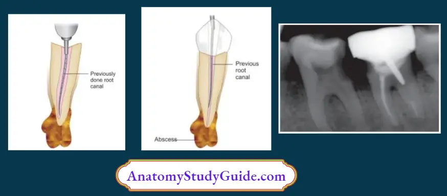 Endodontic-Failures-And-Retreatment-Entry-to-root-canal-after-coronal-dissembly