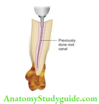 Endodontic Failures And Retreatment Entry to root canal after coronal dissembly.