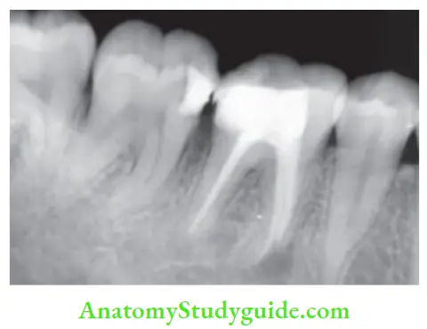 Endodontic Failures And Retreatment Incomplete obturation of mesiobuccal canal of mandibular fist molar due to ledge formation results in periapical radiolucency with respect to mesial root.