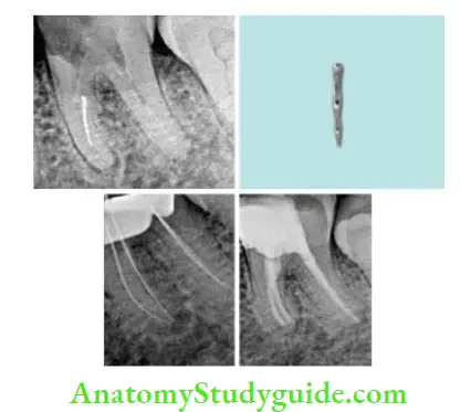 Endodontic Failures And Retreatment Management of Mandibular molar with separated instrument